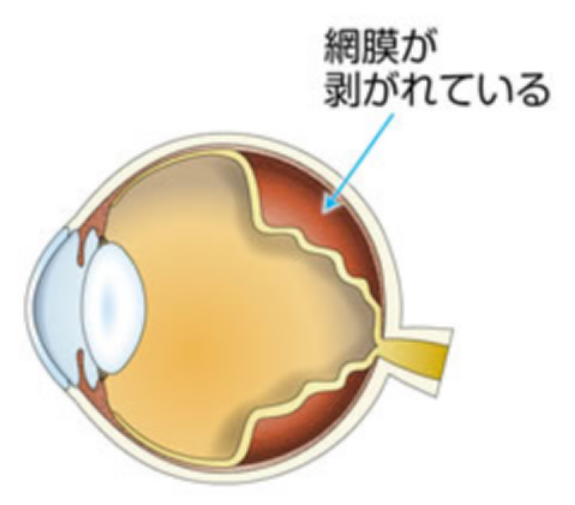 網膜剥離の眼