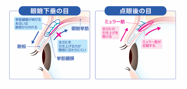眼瞼下垂比較図
